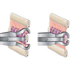 Fixation pliers
